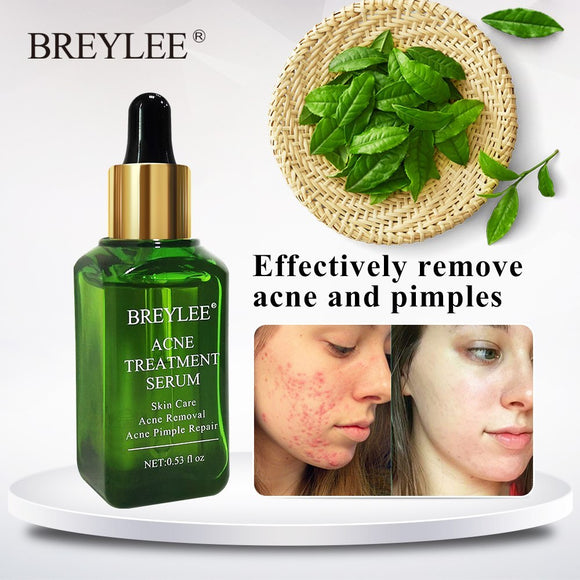 Breylee Acne Treatment Serum, Face Facial Anti Acne Scar Removal Cream, Whitening Skin Repair Pimple Remover Formula