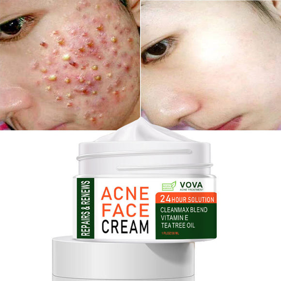 Easy to use and Effective Acne Cream