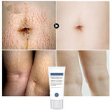 Postpartum Stretch Marks Repair Cream